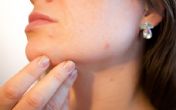 Letnja nega kože: Saveti za sprečavanje akni  usred toplote i vlage