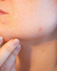 Letnja nega kože: Saveti za sprečavanje akni  usred toplote i vlage